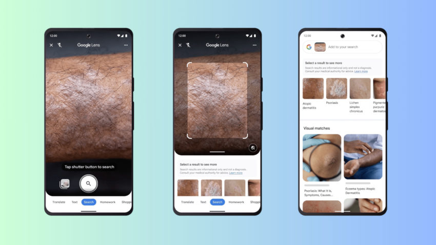 google lens penyakit kulit